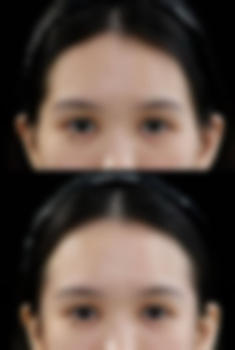 打除皱针有副作用吗