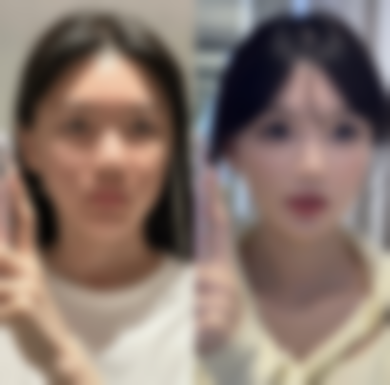 注射玻尿酸丰胸