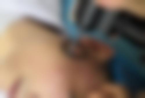 种植头发的危害和后遗症