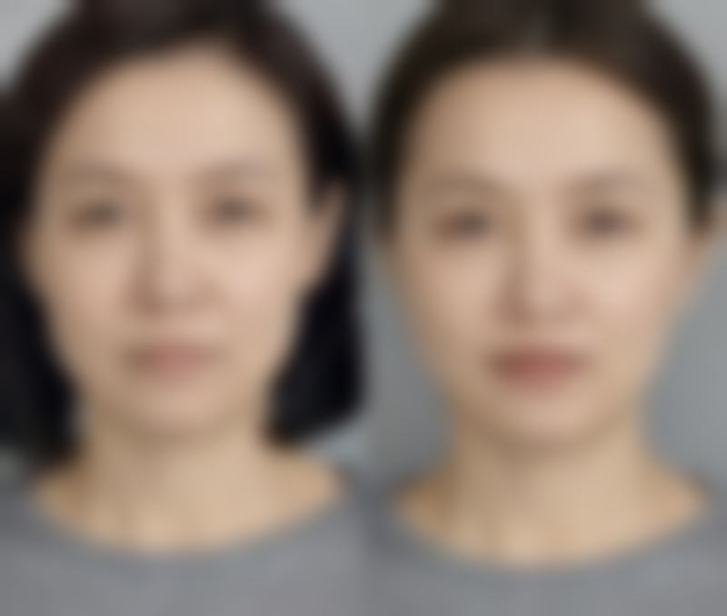 瘦脸针价格参考