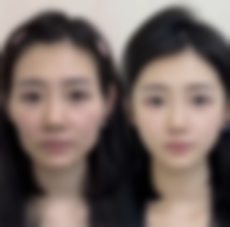 打完瘦脸针多久可以洗脸