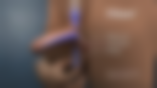 瘦脸针多久打一次成效至佳