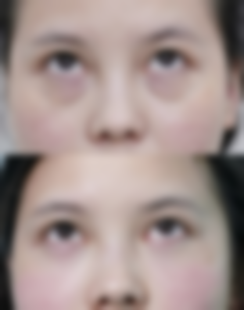 恩施奥莱医疗美容开展的特色项目有面部整形手术、注射美容、激光美容。面部整形手术可以帮助顾客改善面部轮廓,让五官更加精致协调;注射美容能够快速有效地解决肌肤问题,如填充皱纹、改善肌肤松弛等;激光美容则可以针对不同的肌肤问题,如色斑、痘印等进行治疗,让肌肤修复光滑细腻。