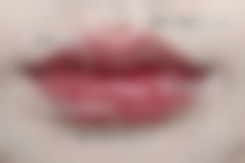 西安部分医院玻尿酸填充太阳穴价格表