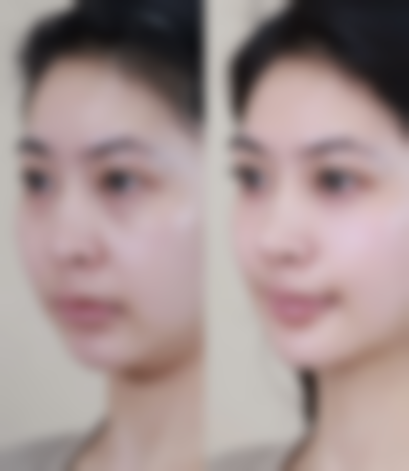 瘦脸针打一次维持多久