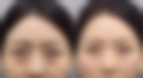 瘦脸针成效消失后会完全回到以前么