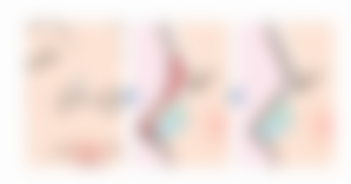 注射瘦脸针的成效与优点