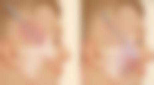 阴式子宫切除+阴道前后壁修补术