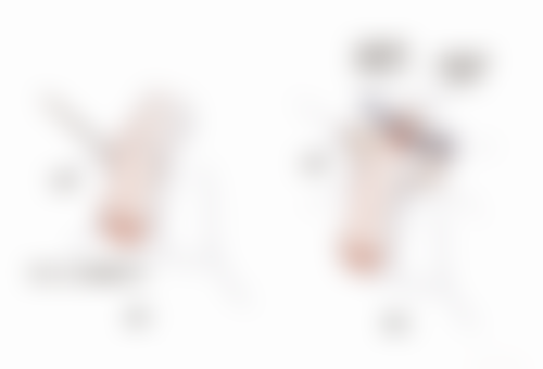 张嘴睡觉导致的凸嘴牙肉外露