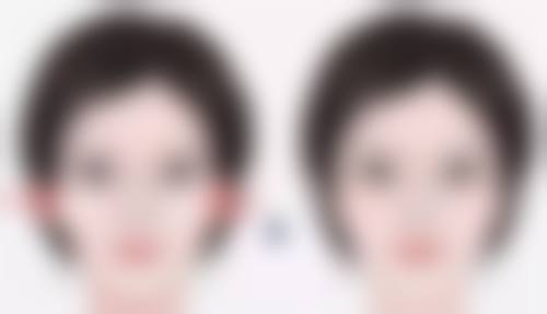 打除皱针的注意事项