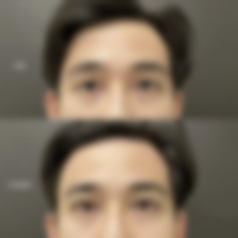 瘦脸针100单位够打两边吗