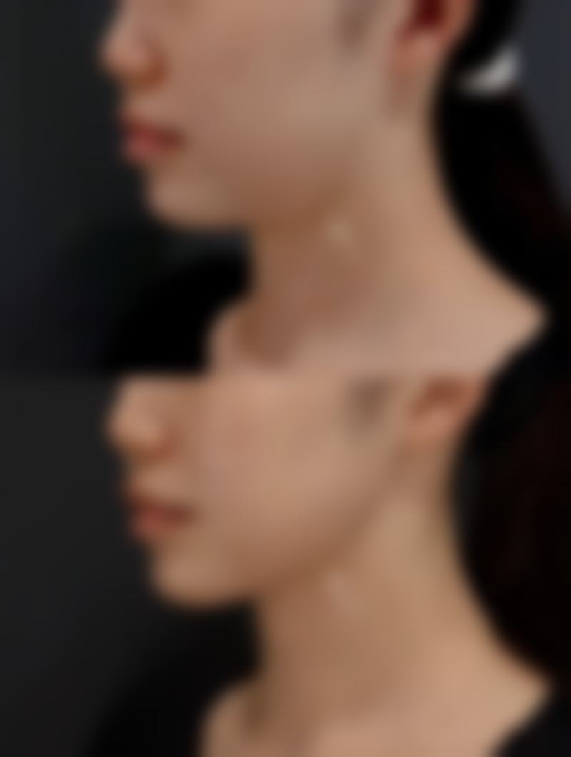 意大利180万美白针的具体成效体现