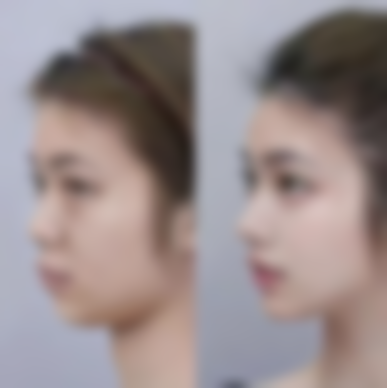 意大利18万美白针的特点