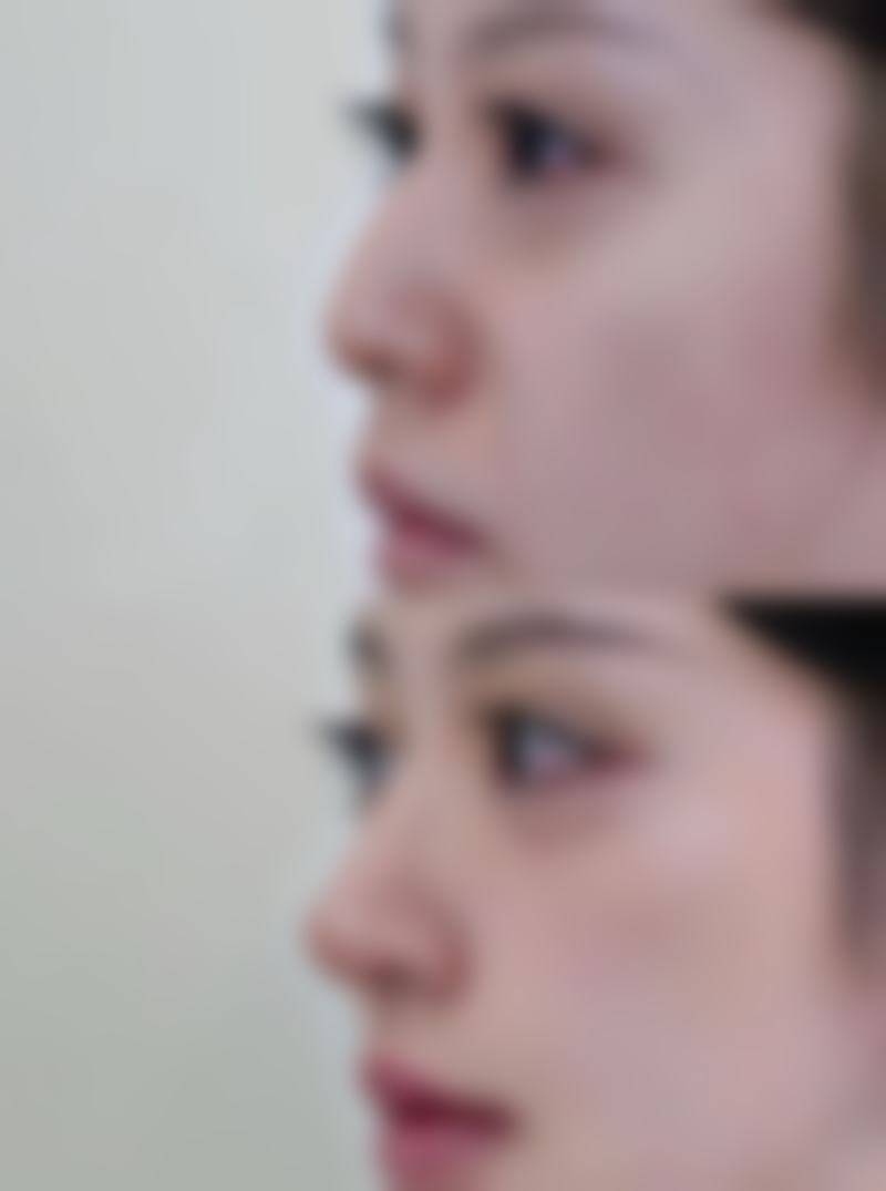 瘦脸针100单位有成效吗