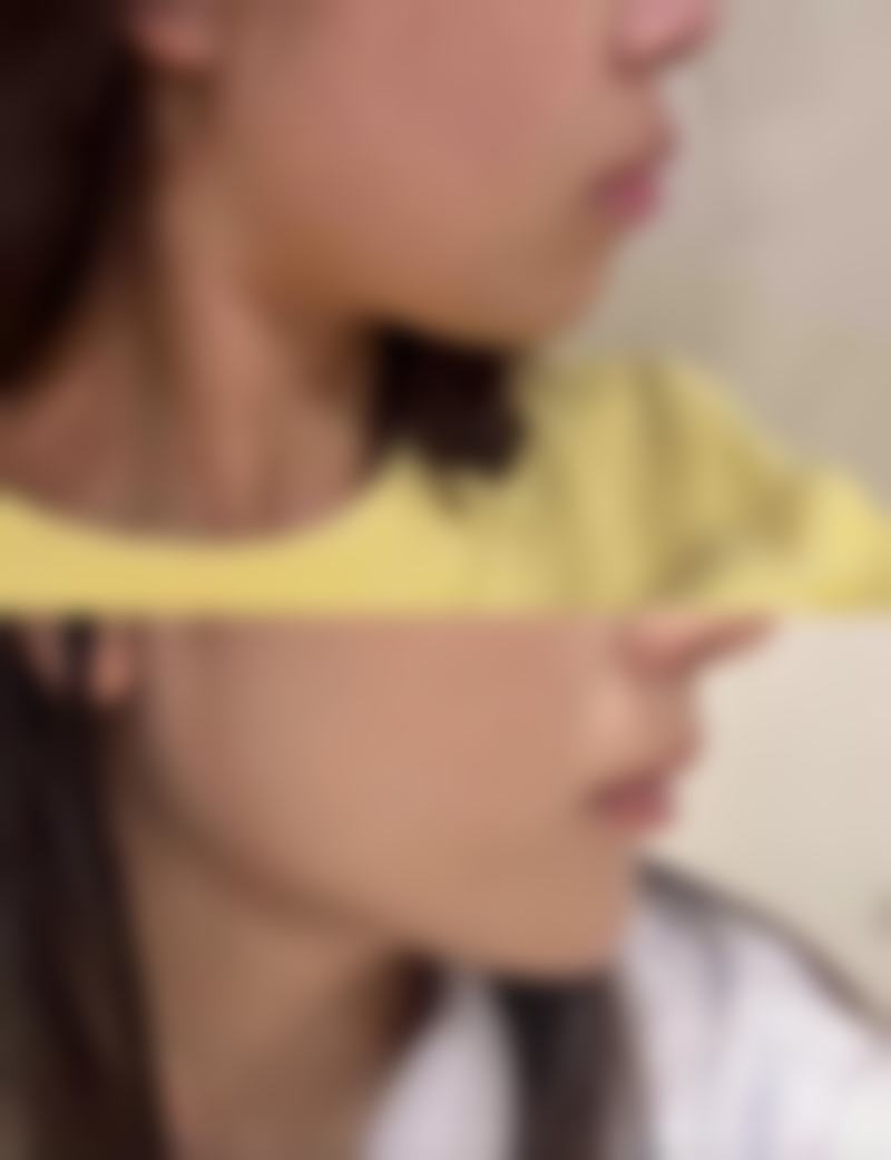 秃顶一般要种植多少单位的头发