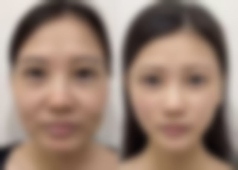 六、除皱针的危害和副作用