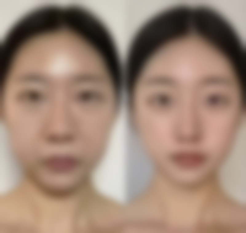 意大利180w美白针的注射方法