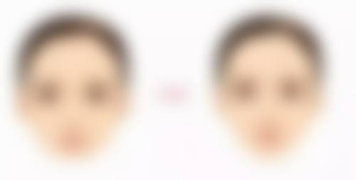 法令纹打除皱可以吗