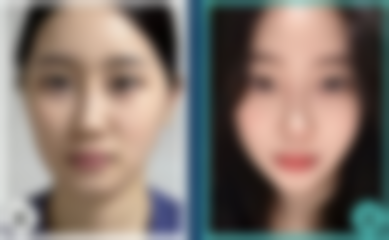 电波拉皮的价格情况