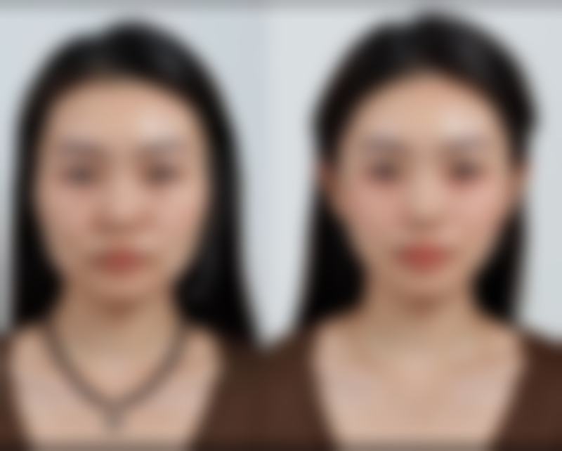 电波拉皮除皱成效是恒久的吗？