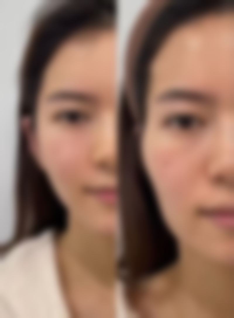 法令纹打去皱针