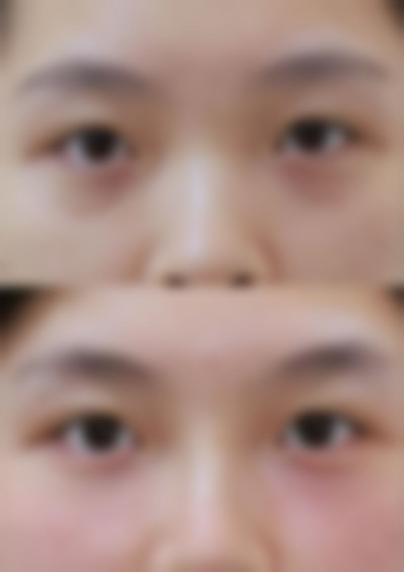 电波拉皮和除皱针哪个成效好？