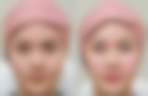 【香河咏颜医疗美容诊所参考价格表：】