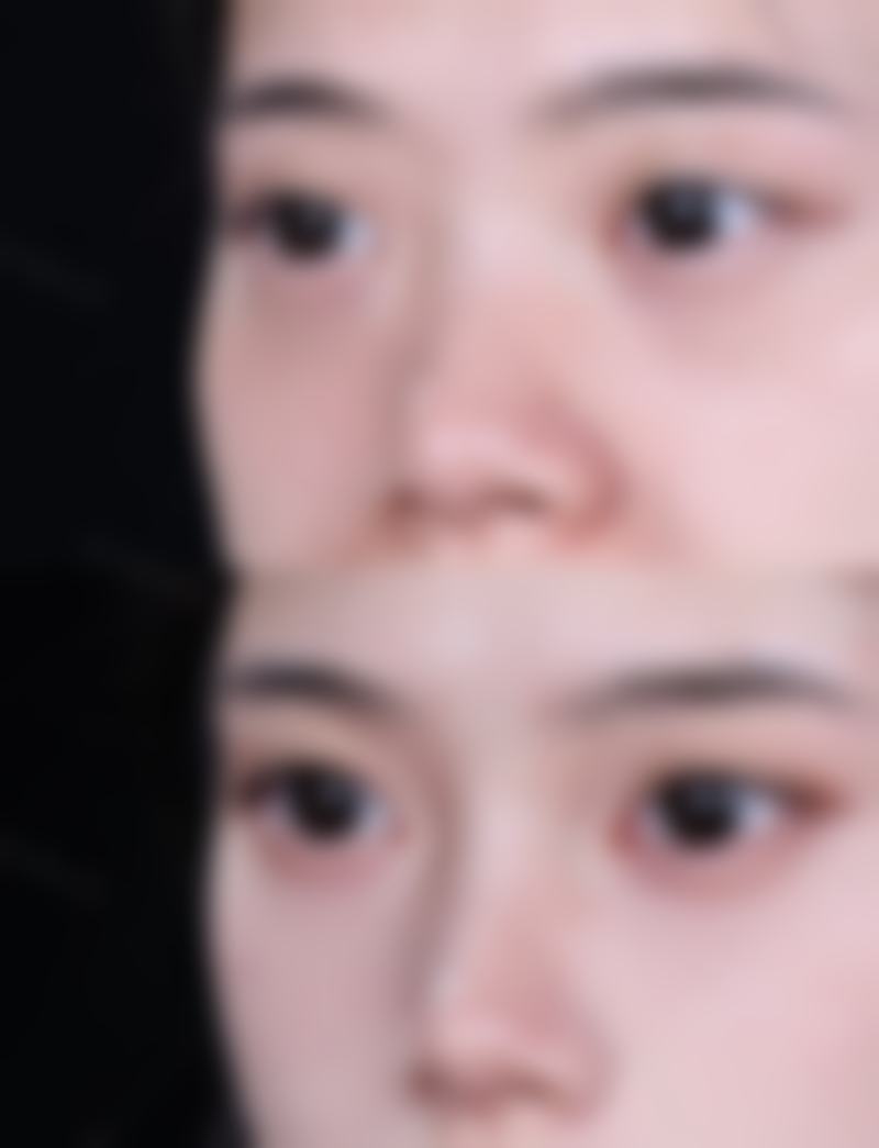 除皱针一般多久打一次更好