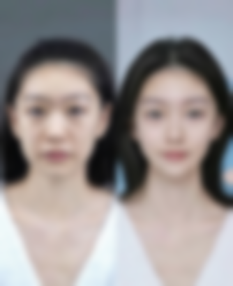 打了瘦脸针后感觉脸僵硬怎么办