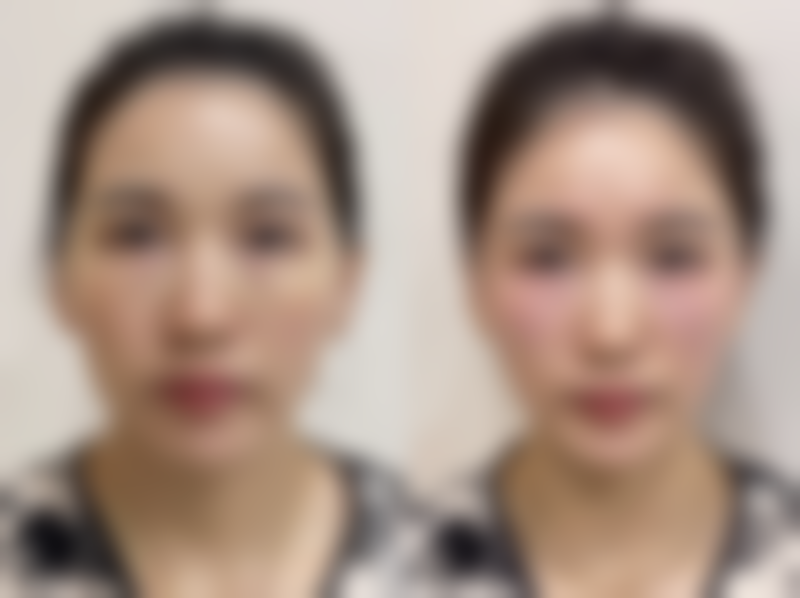 瘦脸针和打下巴有什么区别