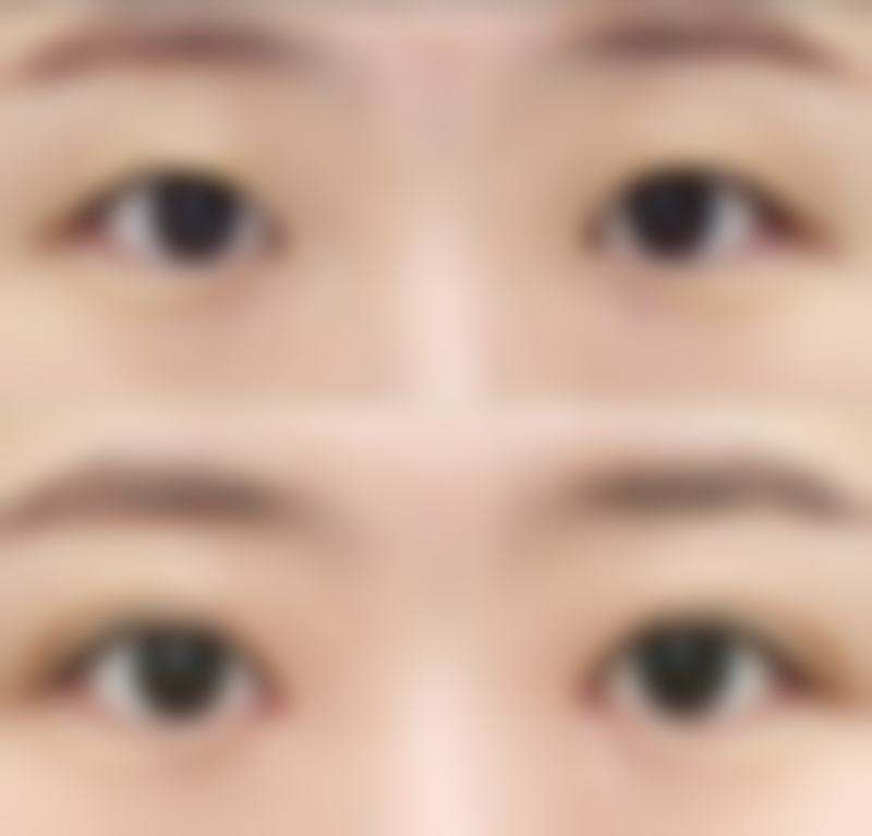 除皱打多了怎么办才能修复