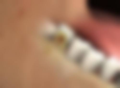 嘴歪脸斜矫正按摩