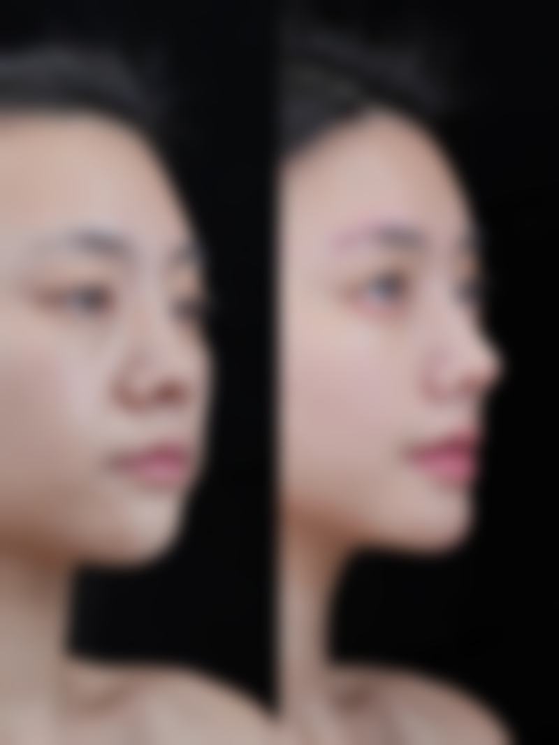 下巴整形术的注意事项