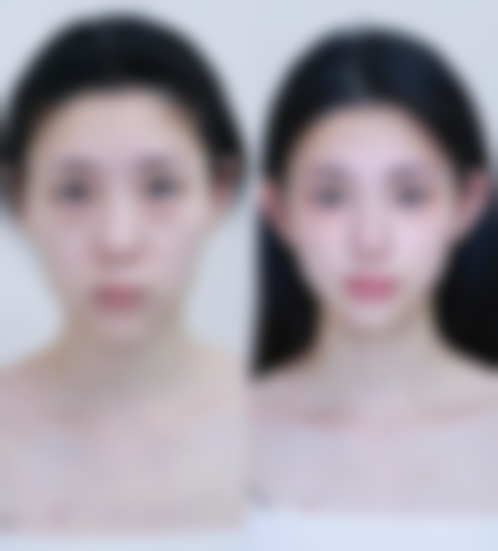 嘴歪脸偏如何矫正