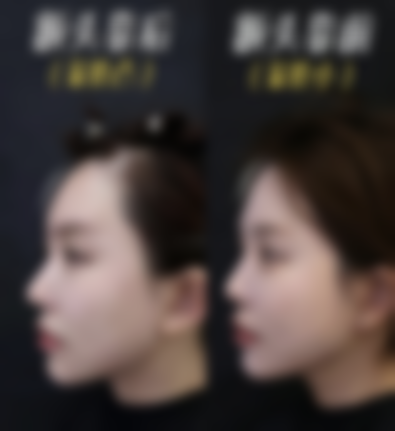 脸歪嘴斜怎么办