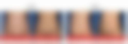 瘦脸针的危害和副作用