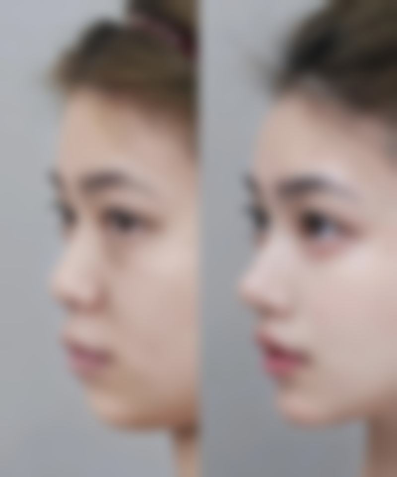 割完包皮多少钱