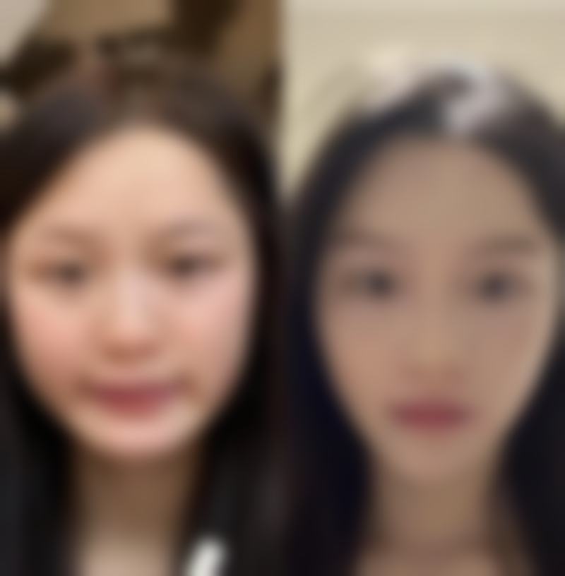 打瘦脸针多长时间可以化妆