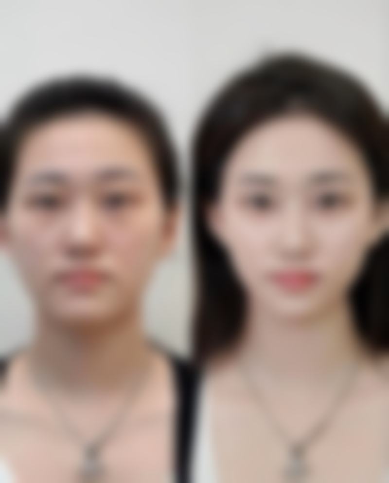 丰太阳穴适合什么脸型