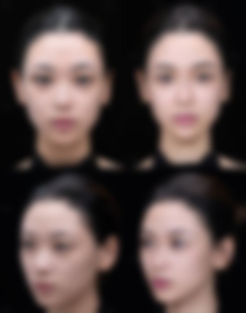 打瘦脸针有后遗症吗