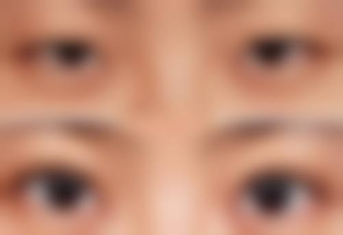 瘦脸治疗后的注意事项