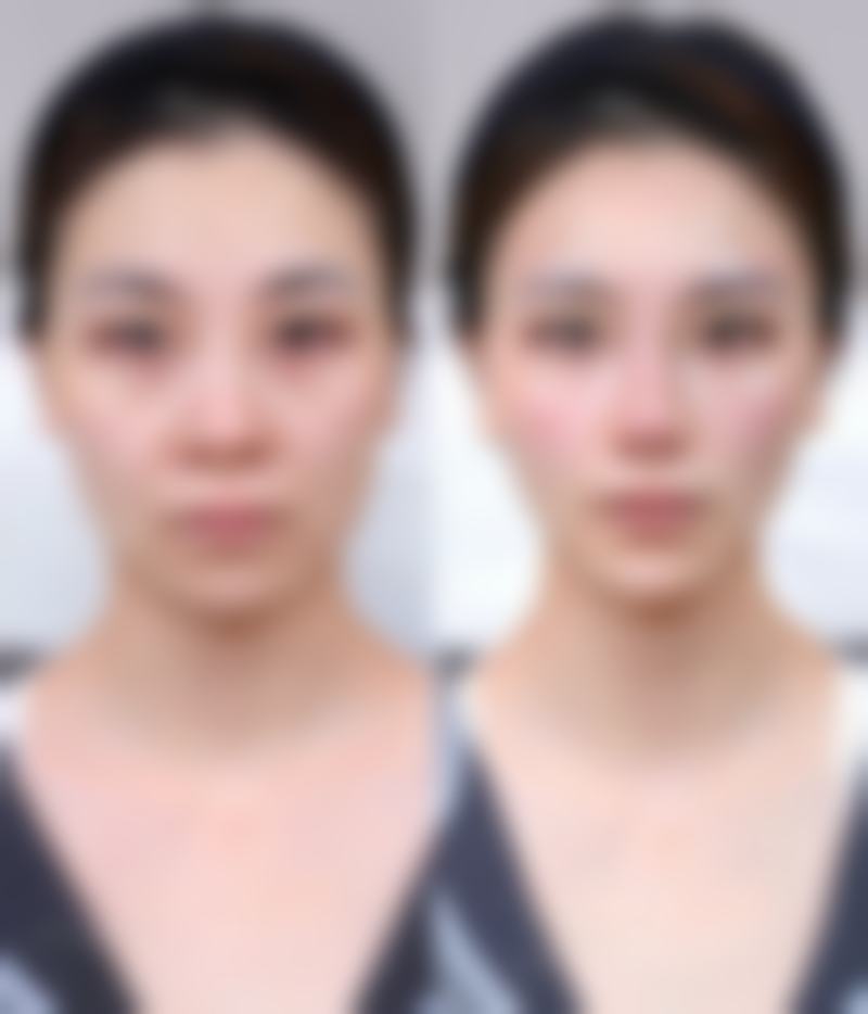 瘦脸针多久开始见成效
