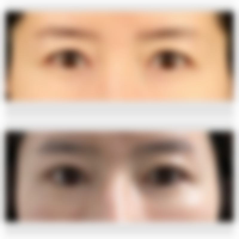 美白针的适用人群和注意事项