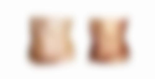 地包天牙齿有几种矫正方法