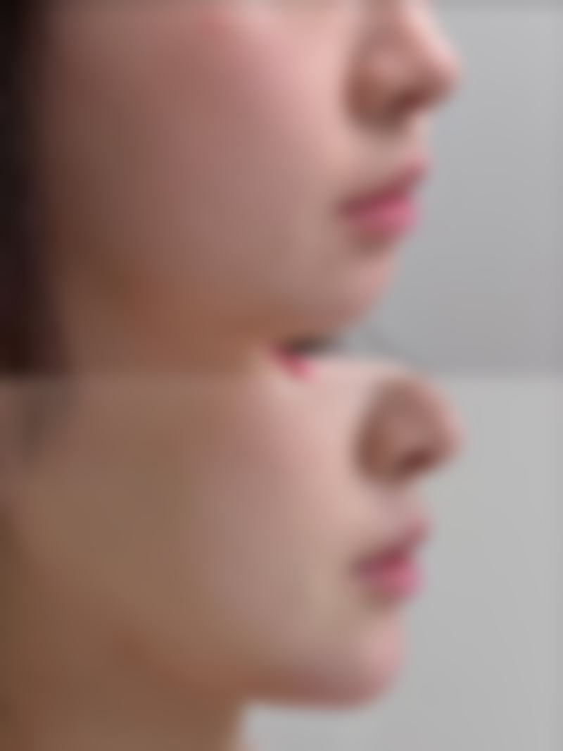 嘴凸下巴后缩做什么手术
