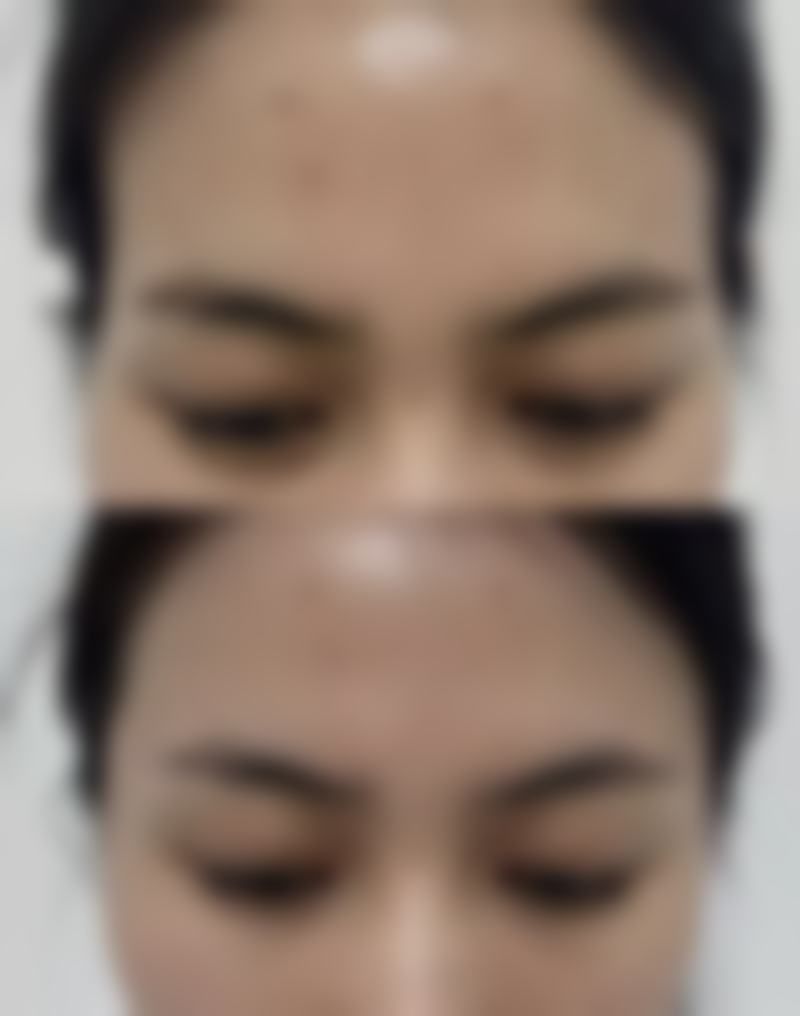 怀孕期间打瘦脸针有成效吗
