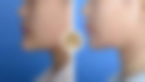 注射除皱针的注意事项