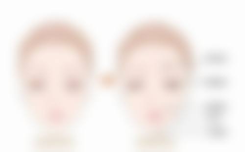 瘦脸针打多久咬肌消失了