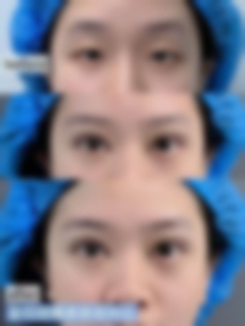 瘦脸针打完多久咬肌变软