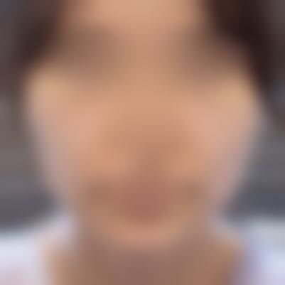 韩国TS整形医院李相均隆胸手术成效适合吗